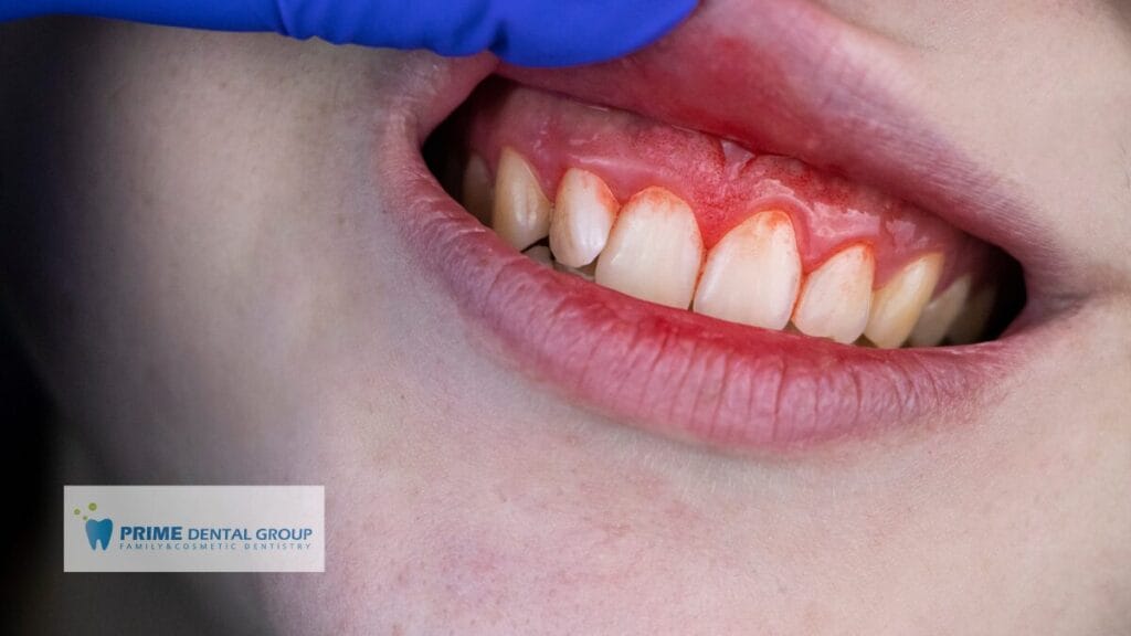 Close-up of inflamed gums showing early signs of gum disease.